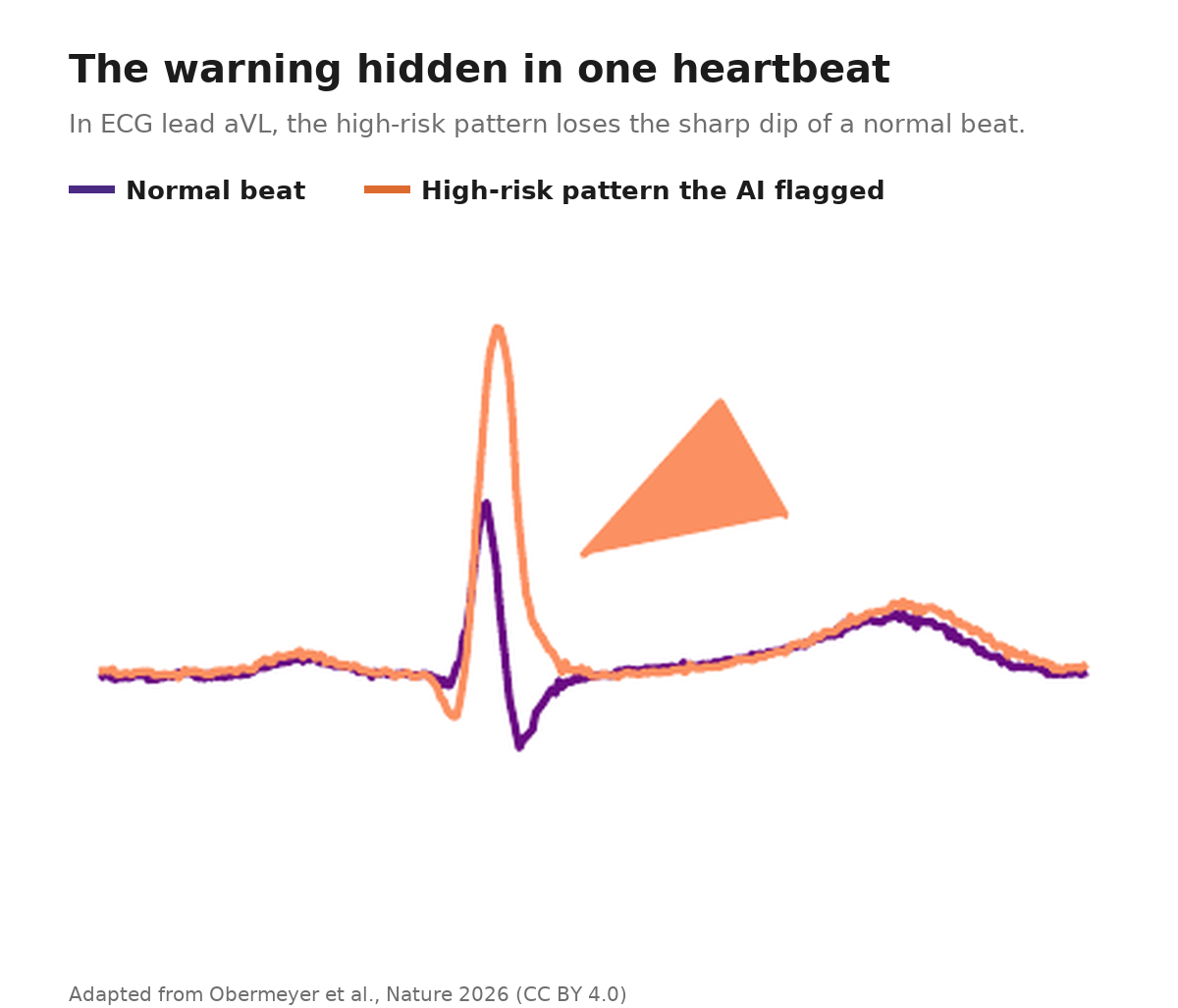 AI Found a Sudden-Death Signal Hiding in a Routine ECG